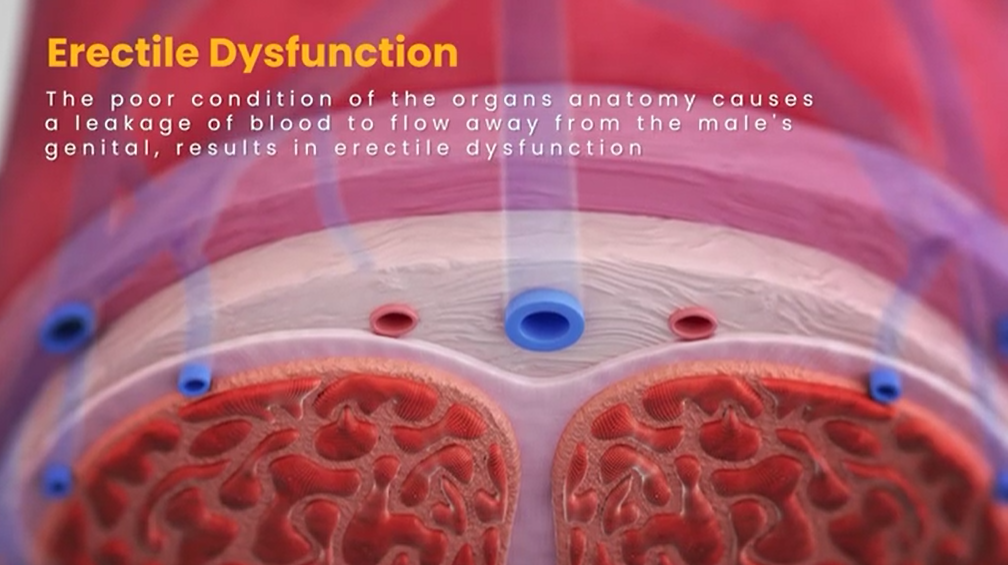 פין במצב רפוי