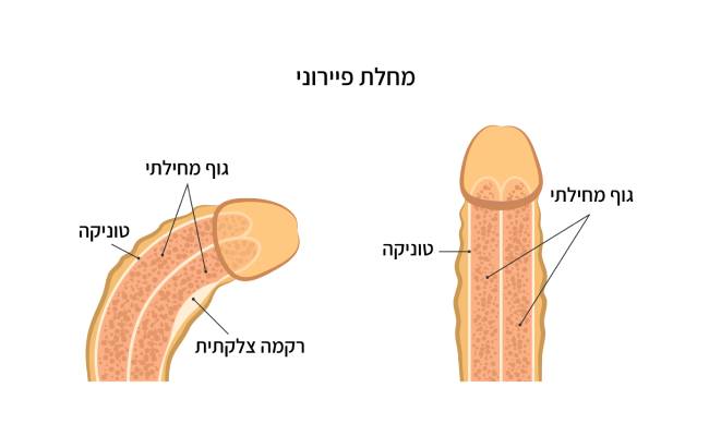 מה זה מחלת פיירוני?